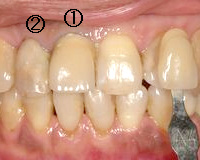 施術前　①と②はかぶせ物です